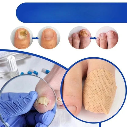 210pcs Waterproof Nail Fungus Correction Patch Finger Guard Bandage Nail Fungus Hollow Nail Cover Disguise Patch Toenail Care